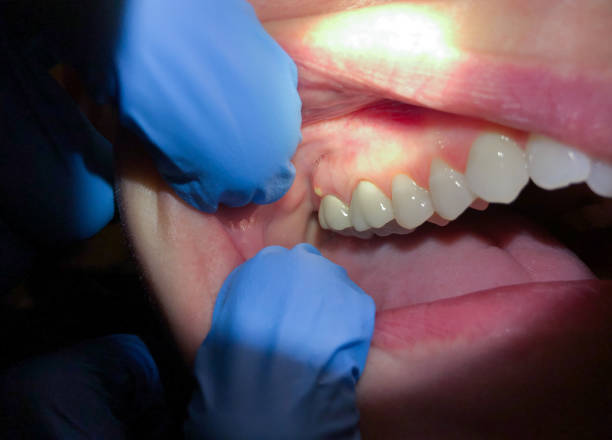 Best Urgent Care for Lost Fillings or Crowns in Rantoul, IL